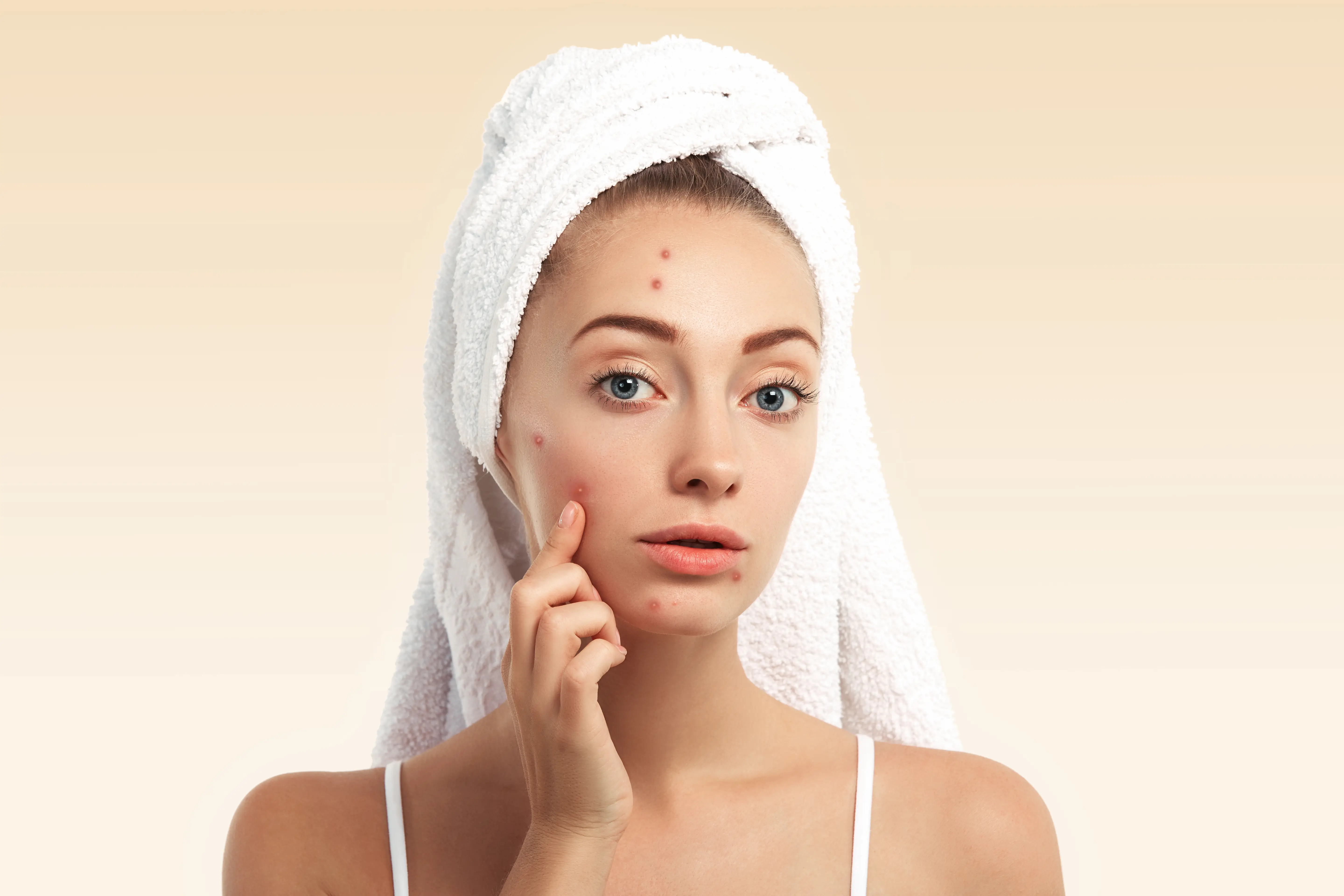 Teenage girl with acne on face showing that acne is not just a teenage condition